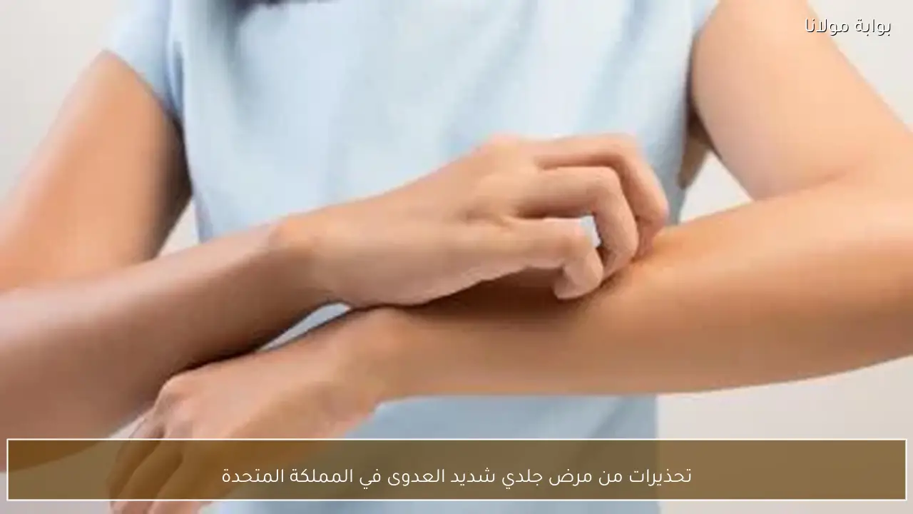 تحذيرات من مرض جلدي شديد العدوى في المملكة المتحدة