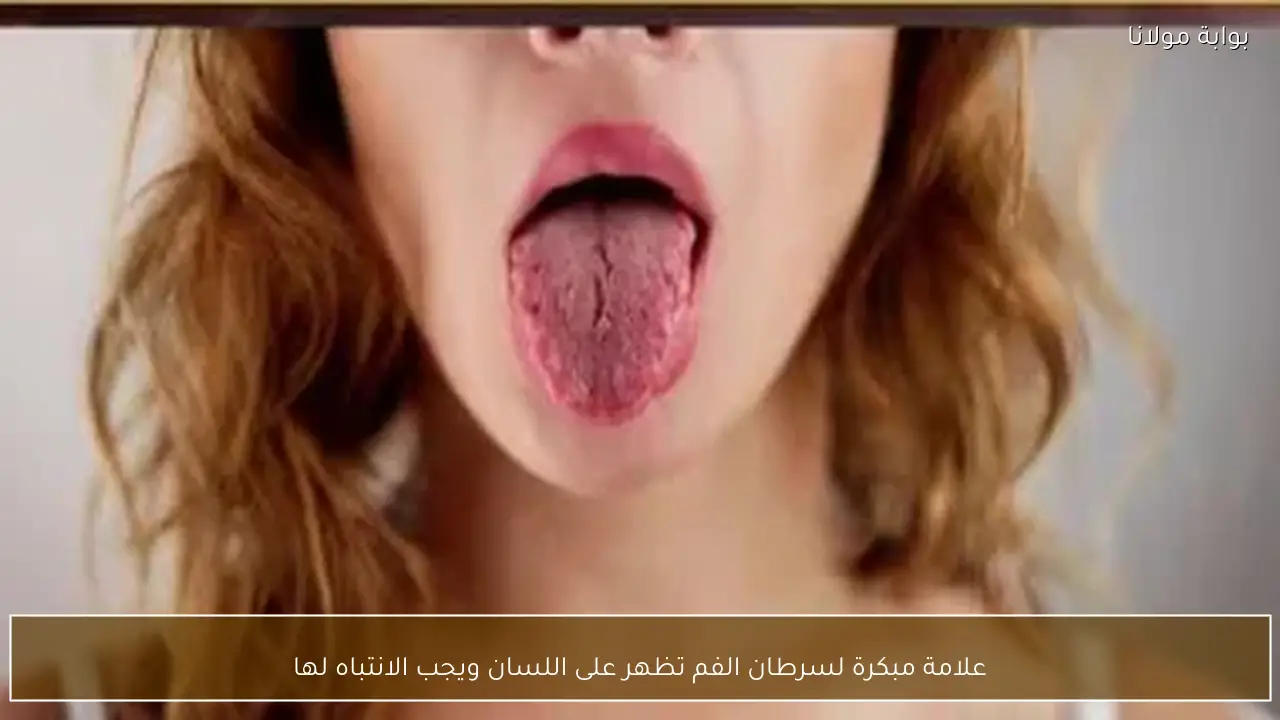 علامة مبكرة لسرطان الفم تظهر على اللسان ويجب الانتباه لها