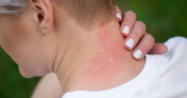 فيروس الشيكونجونيا.. ما هى أبرز أعراضه وأسبابه وطرق الوقاية والعلاج