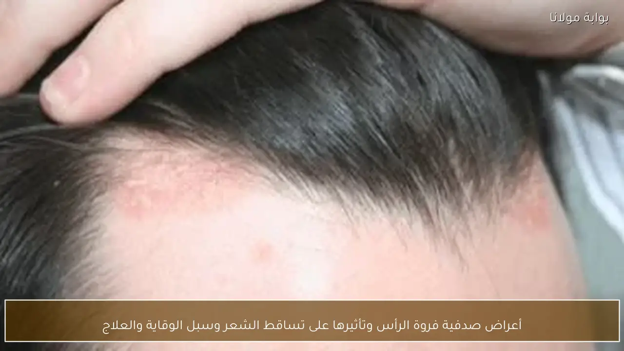 أعراض صدفية فروة الرأس وتأثيرها على تساقط الشعر وسبل الوقاية والعلاج